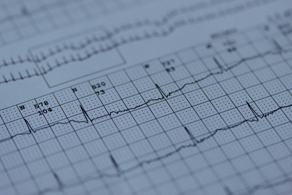 ECG